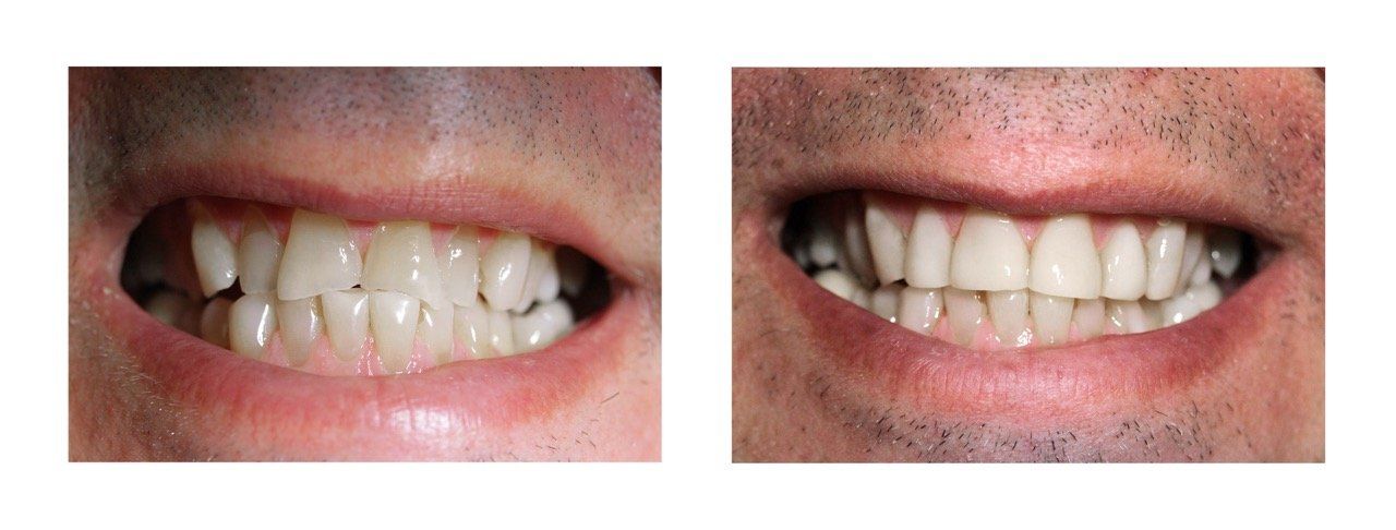A before and after picture of a man 's teeth.