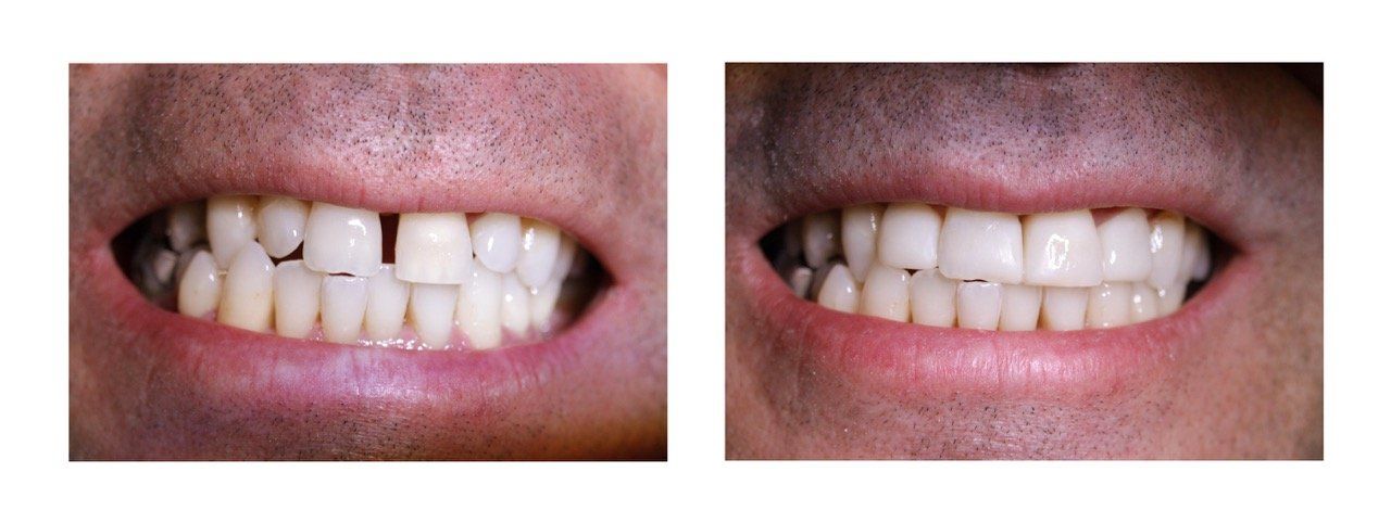 A before and after picture of a man 's teeth.