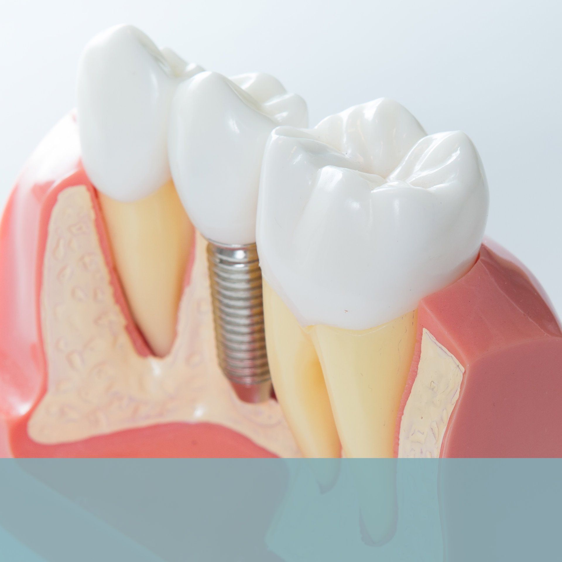 Gentle Touch Family Dentistry - Dental Implant