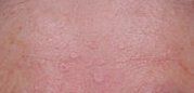 Prevent hyperplasia