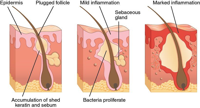best skin care tips for acne