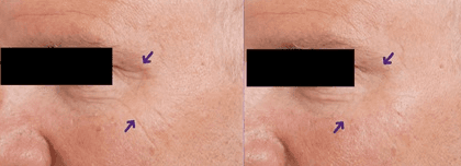A before and after photo of a man 's face with arrows pointing to the eyebrows.