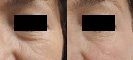 antiaging eye treatment-wrinkle free
