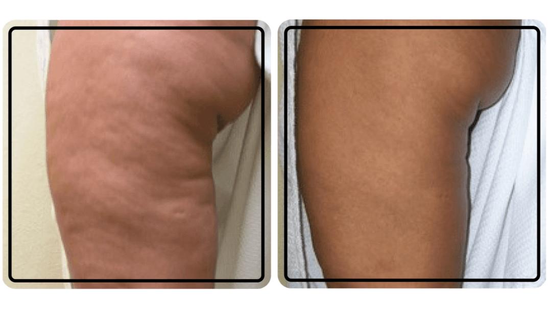 Skin Tightening For Cellulite reduction- Philadelphia
