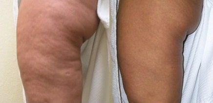 Cellulite reduction &Body Sculpting Cellulite treatment