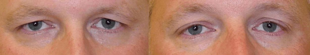 Anti-Aging Eye Care at Max Aesthetics Philadelphia
