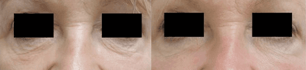 wringkl eye treatment- '.