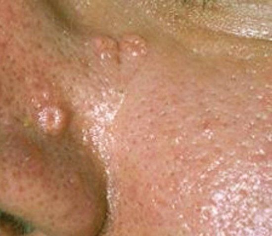 skin treatment