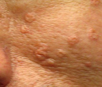 Sebaceous Hyperplasia Treatment