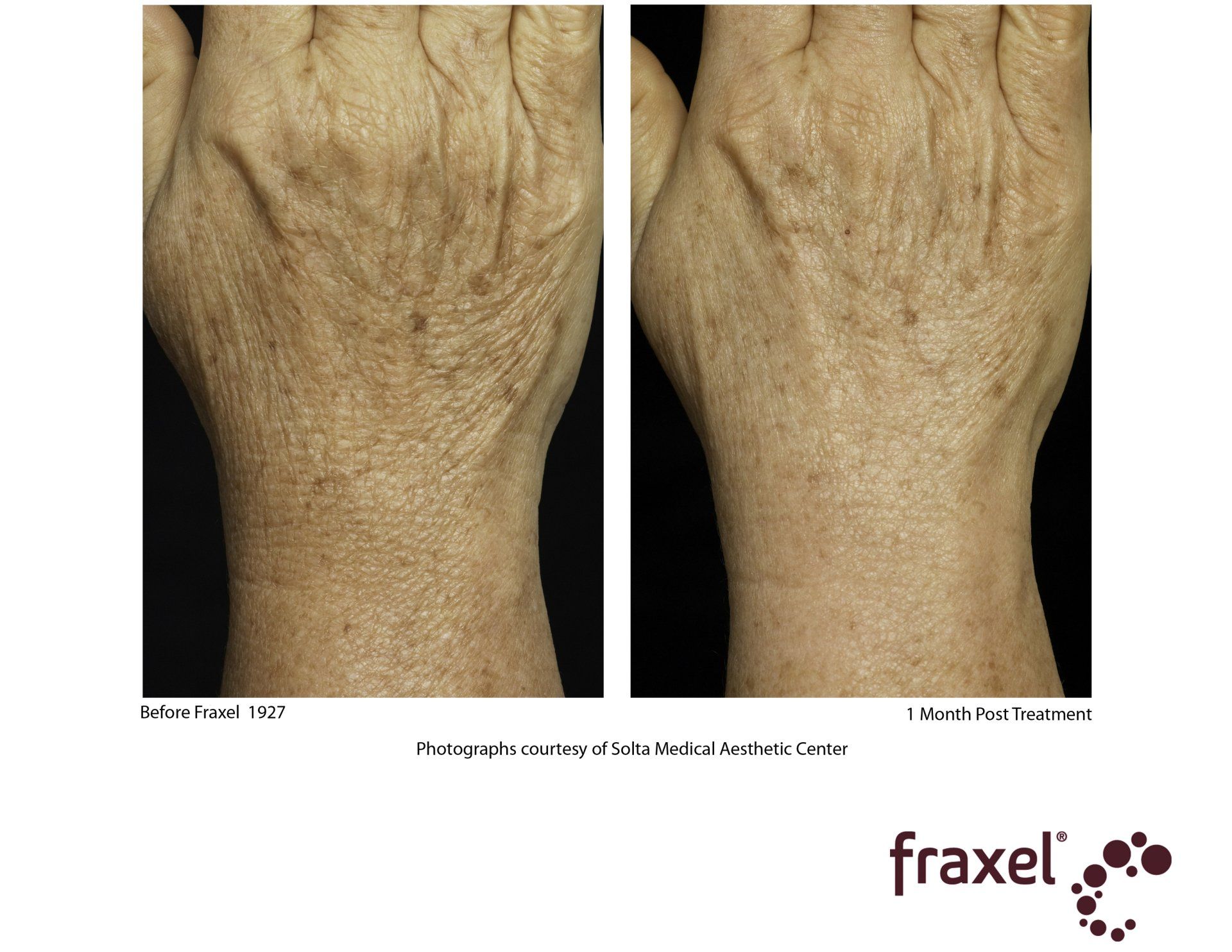 fraxel before and after photos