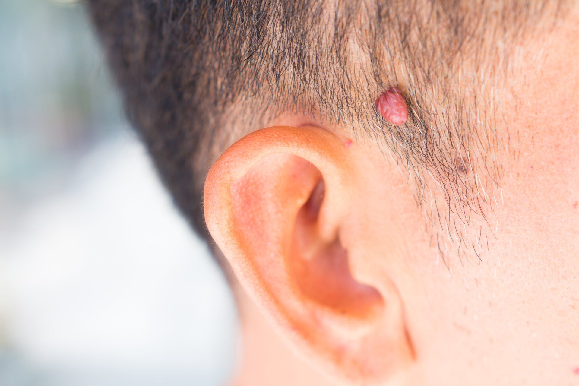 man with mole on side of face