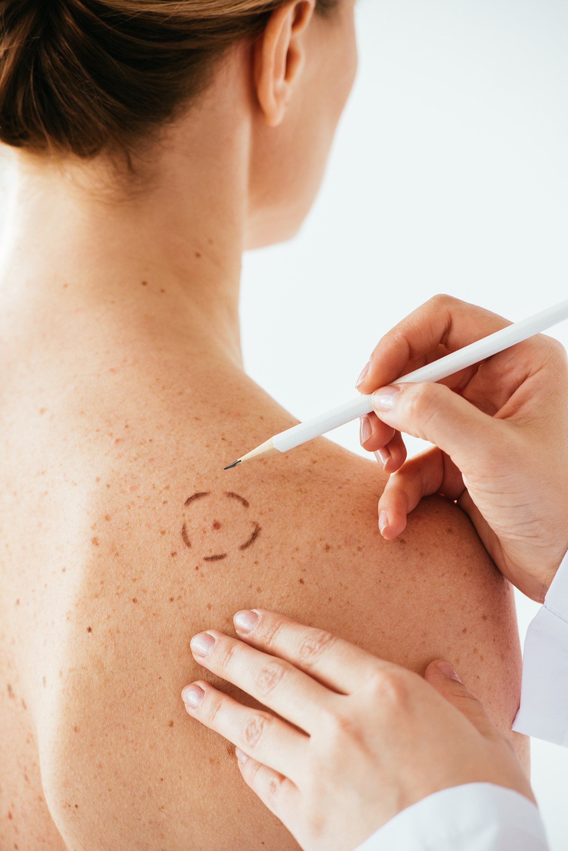 dermatologist drawing circle on persons back