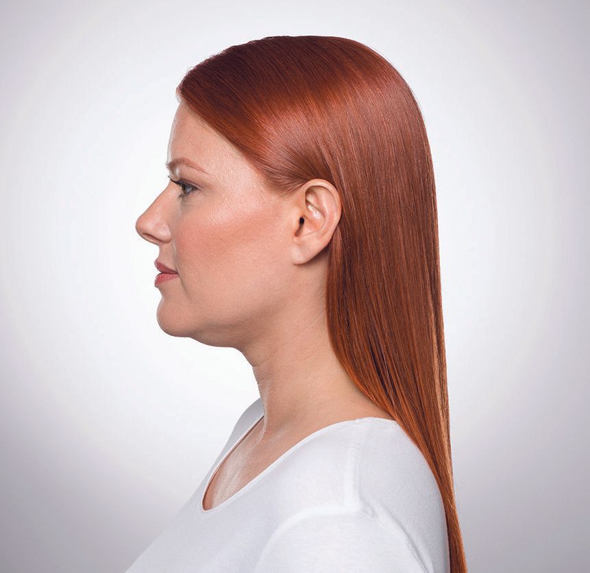 Kybella before and after photos