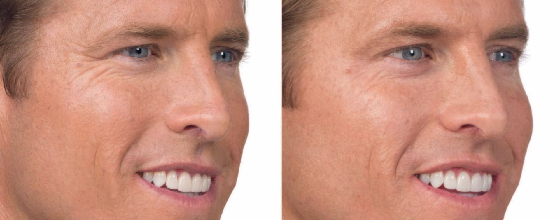 Botox before and after photos
