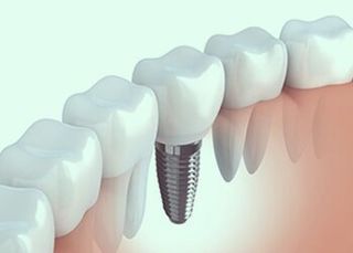 Implants—Dentists in Whittier, NC Implants—Dentists in Whittier, NC