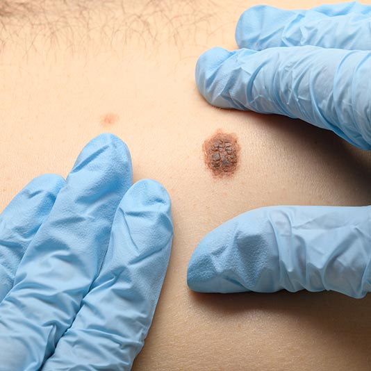 Doctors Examining Patients Skin with Mole — Charleston, WV — H. Richard Reynolds, M.D.