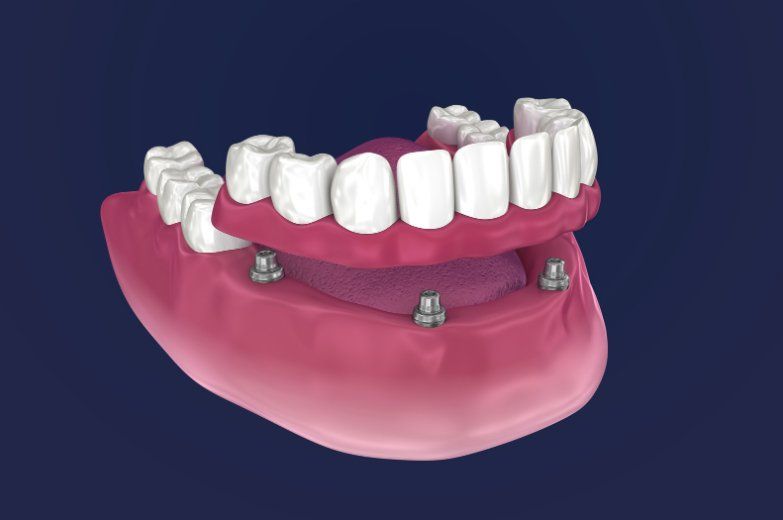 Front view of all on 4 implants being placed on the upper mandibular arch. At Kipnis Dental implant clinic taken on December 2019.