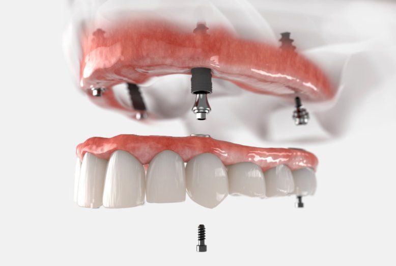 All on 6 implants for lower mandible at Kipnis Dental implant center in Brooklyn NY
