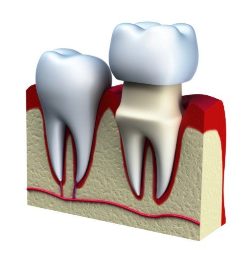 Dental crown being placed on prepared site for patient at Kipnis Dental crown center in Brooklyn NY