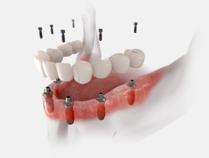 All on 6 implants for upper mandible at Kipnis Dental implant center in Brooklyn NY