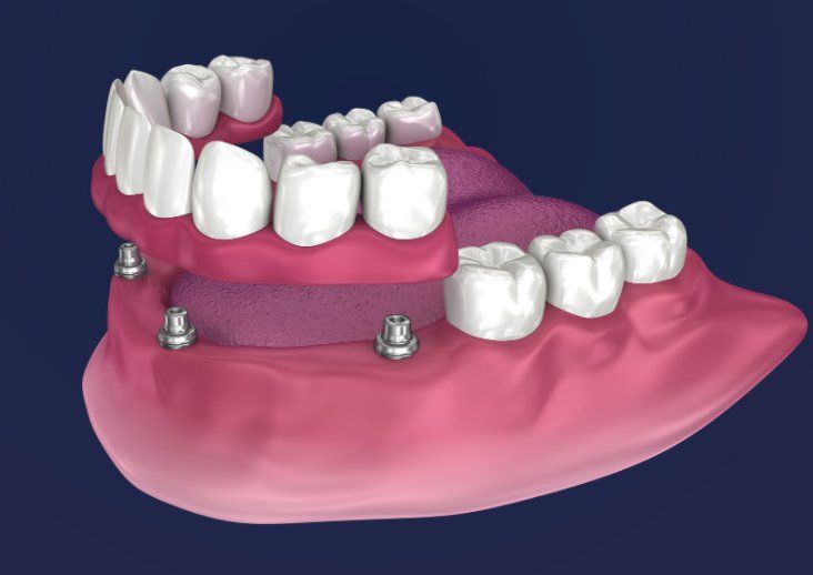 history of cost of dental implants for tooth loss in brooklyn