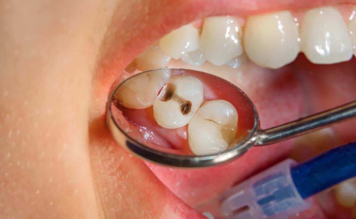 Una persona está siendo examinada por un dentista.