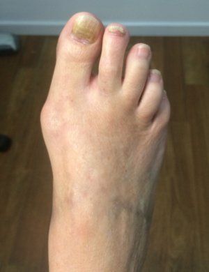 fungal nail infection