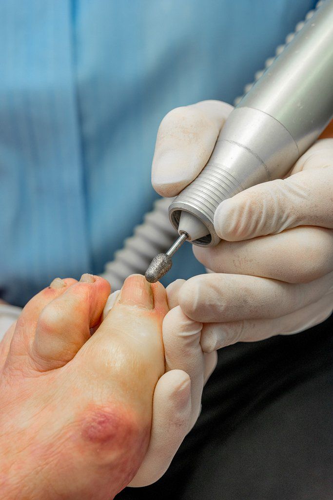 INGROWING TOE NAIL TREATMENT