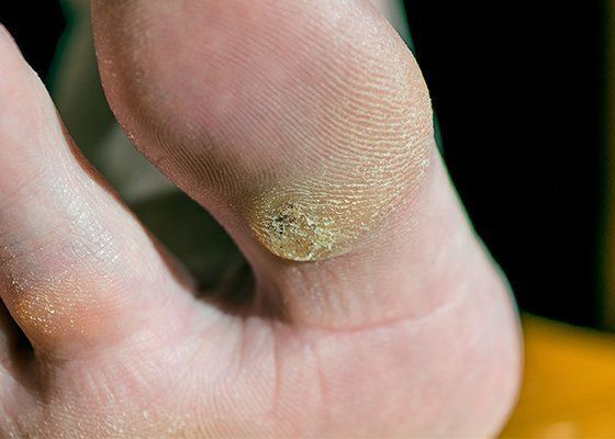 Plantar Warts
