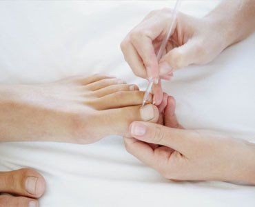 Ingrown toenails