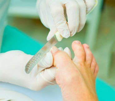 ingrown toenail
