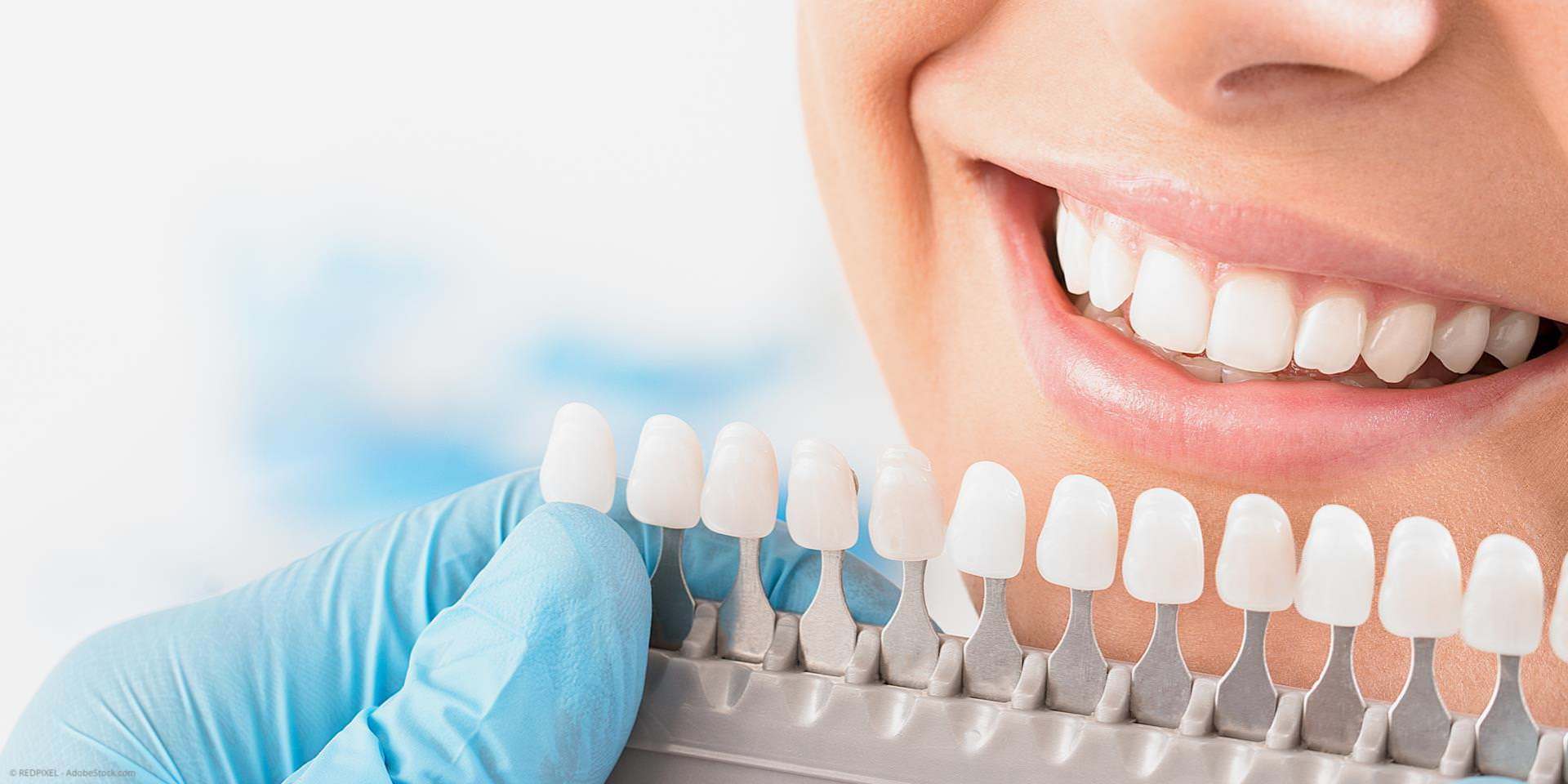 Schöne weiße Zähne mit Bleaching (Zahnaufhellung), Veneers und mehr