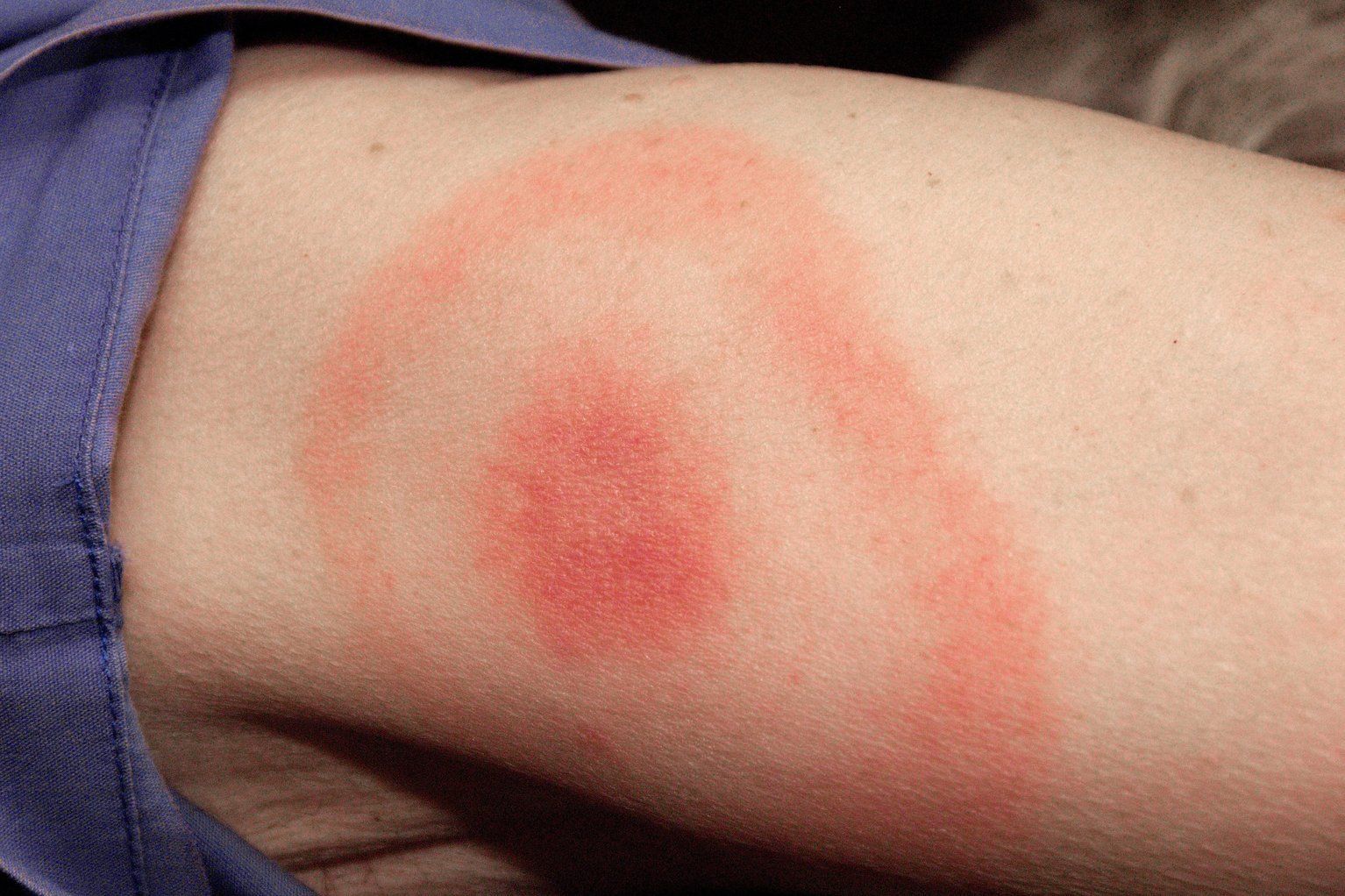 Lyme Disease Rash