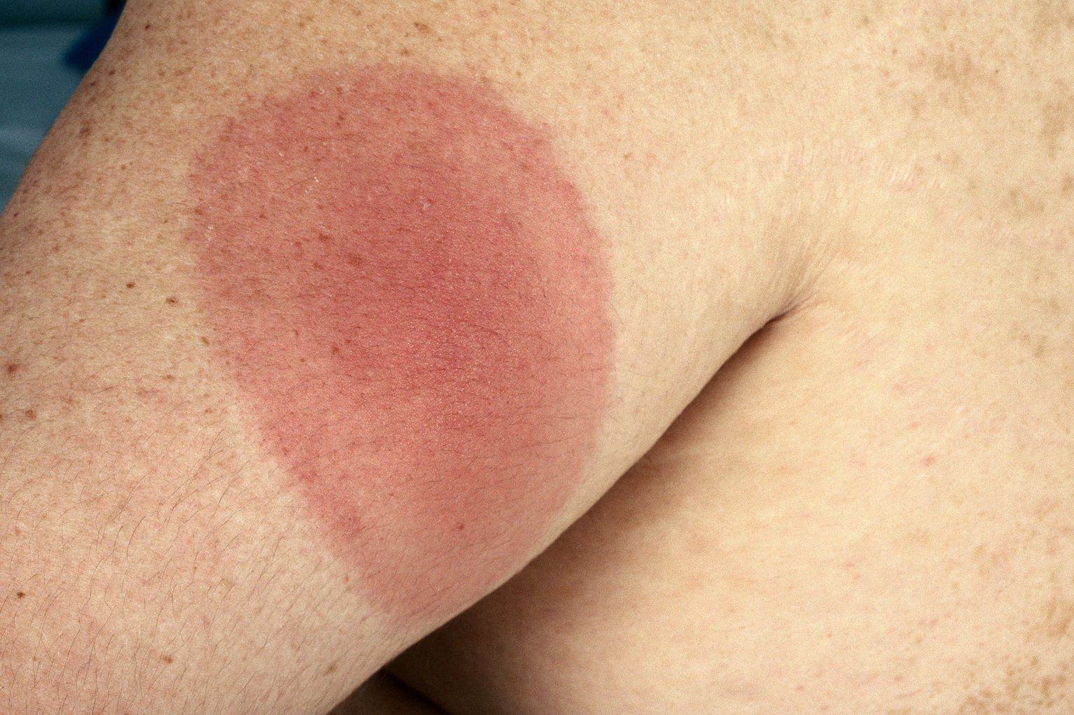 Lyme Disease Rash