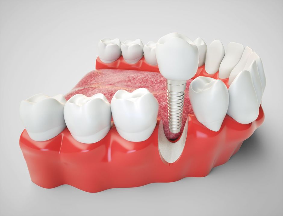 Dente impiantato