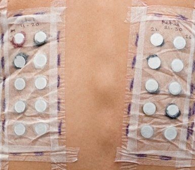 prick test