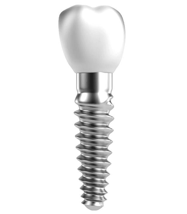dental tooth implant illustration of tooth implant