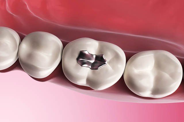 illustration of amalgam filling