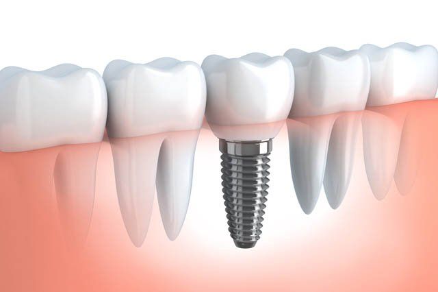 tooth implant diagram of tooth implant in mouth