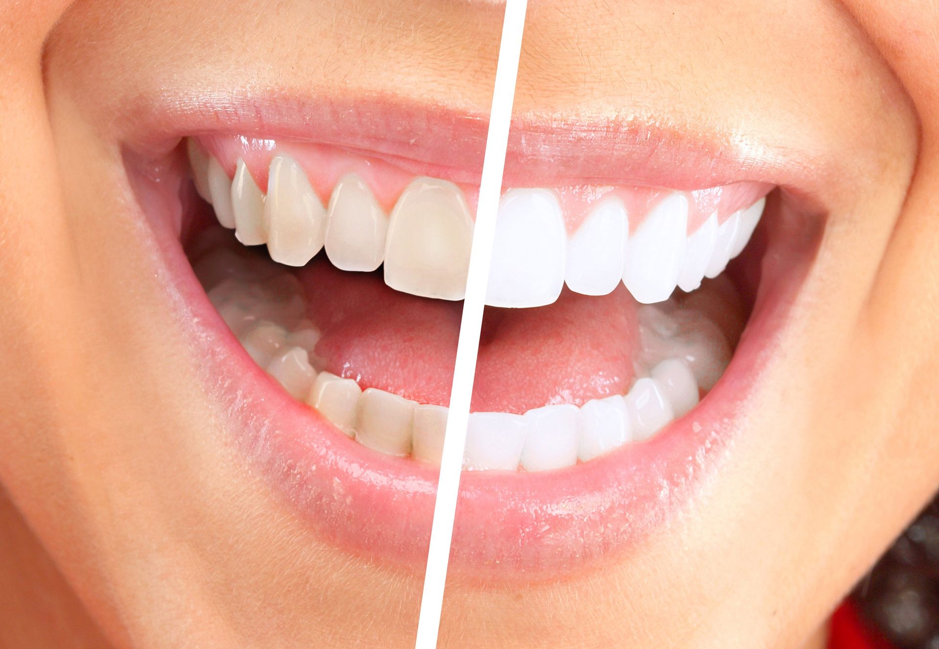 professional whitening system