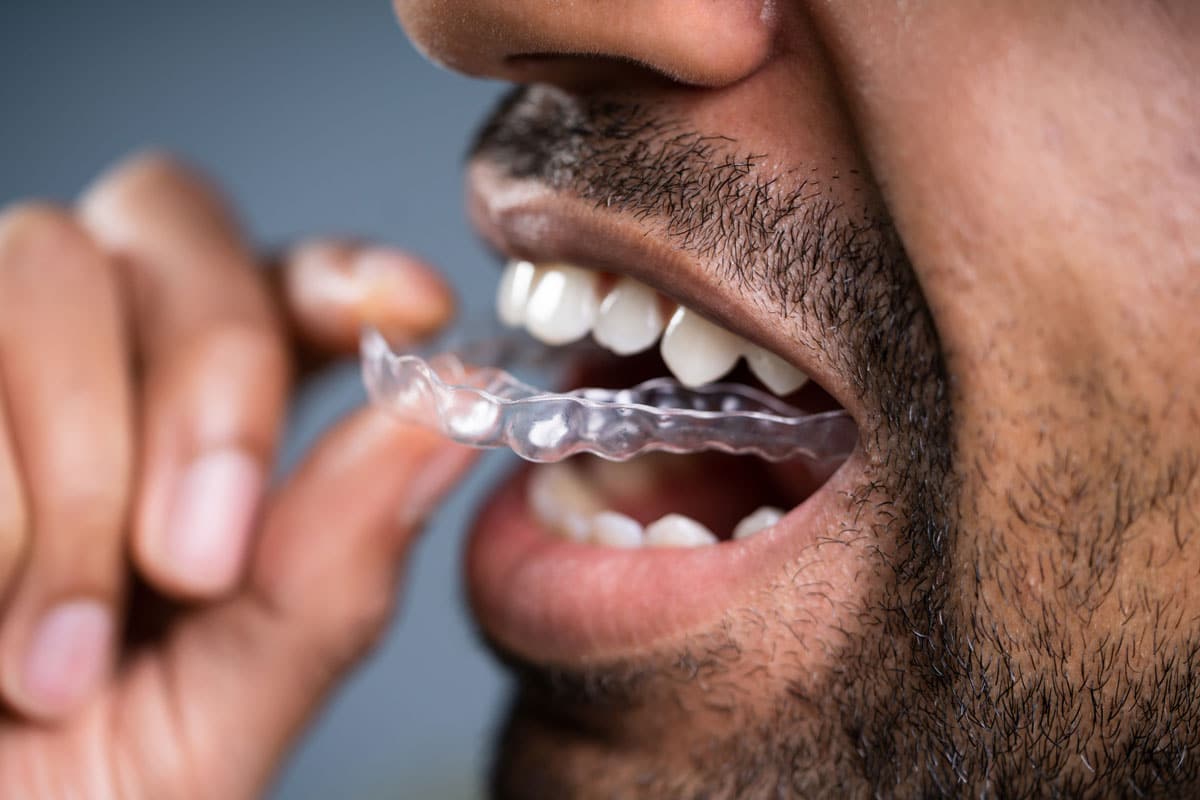 Invisalign Brooklyn