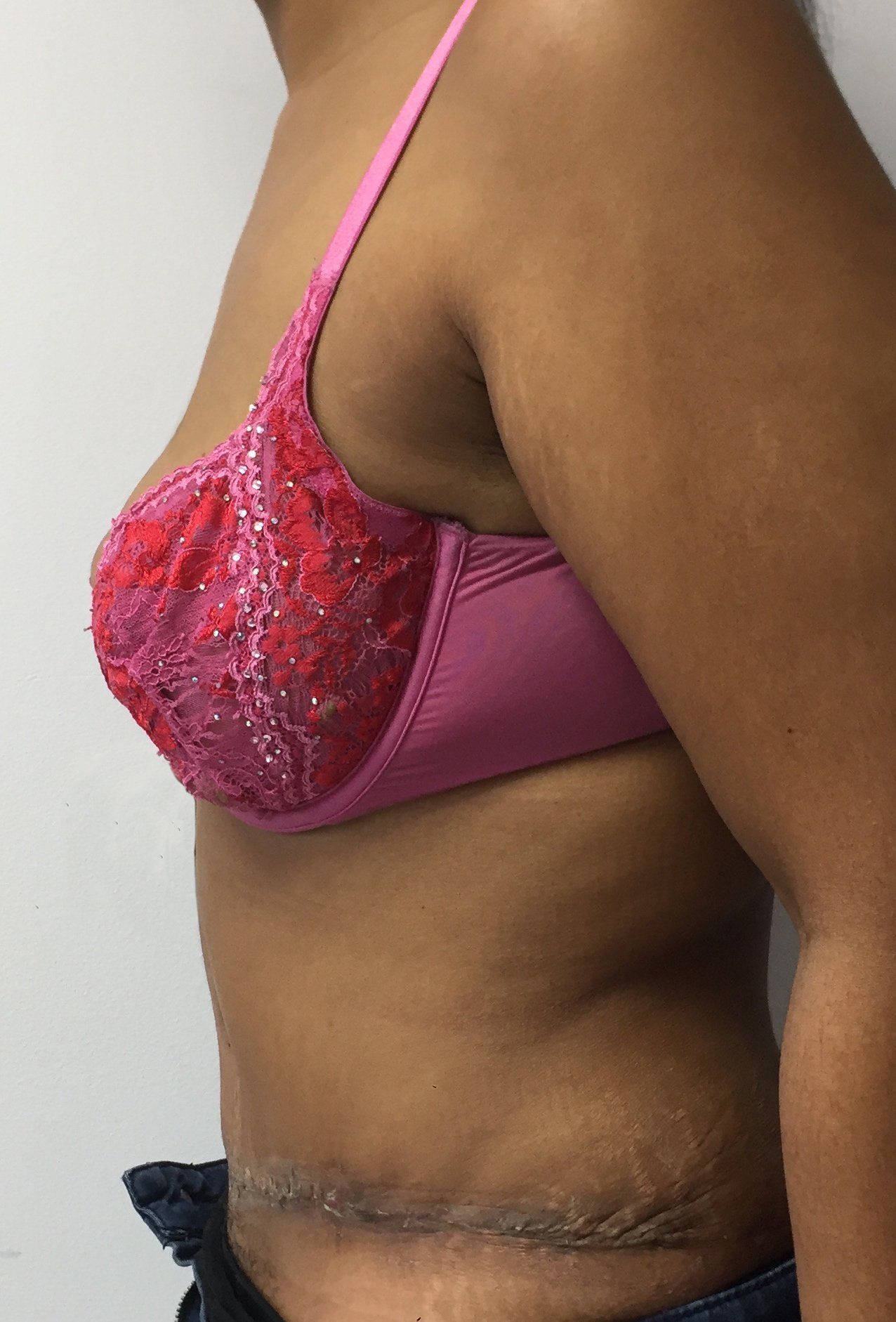 Abdominoplasty pre cropped 1