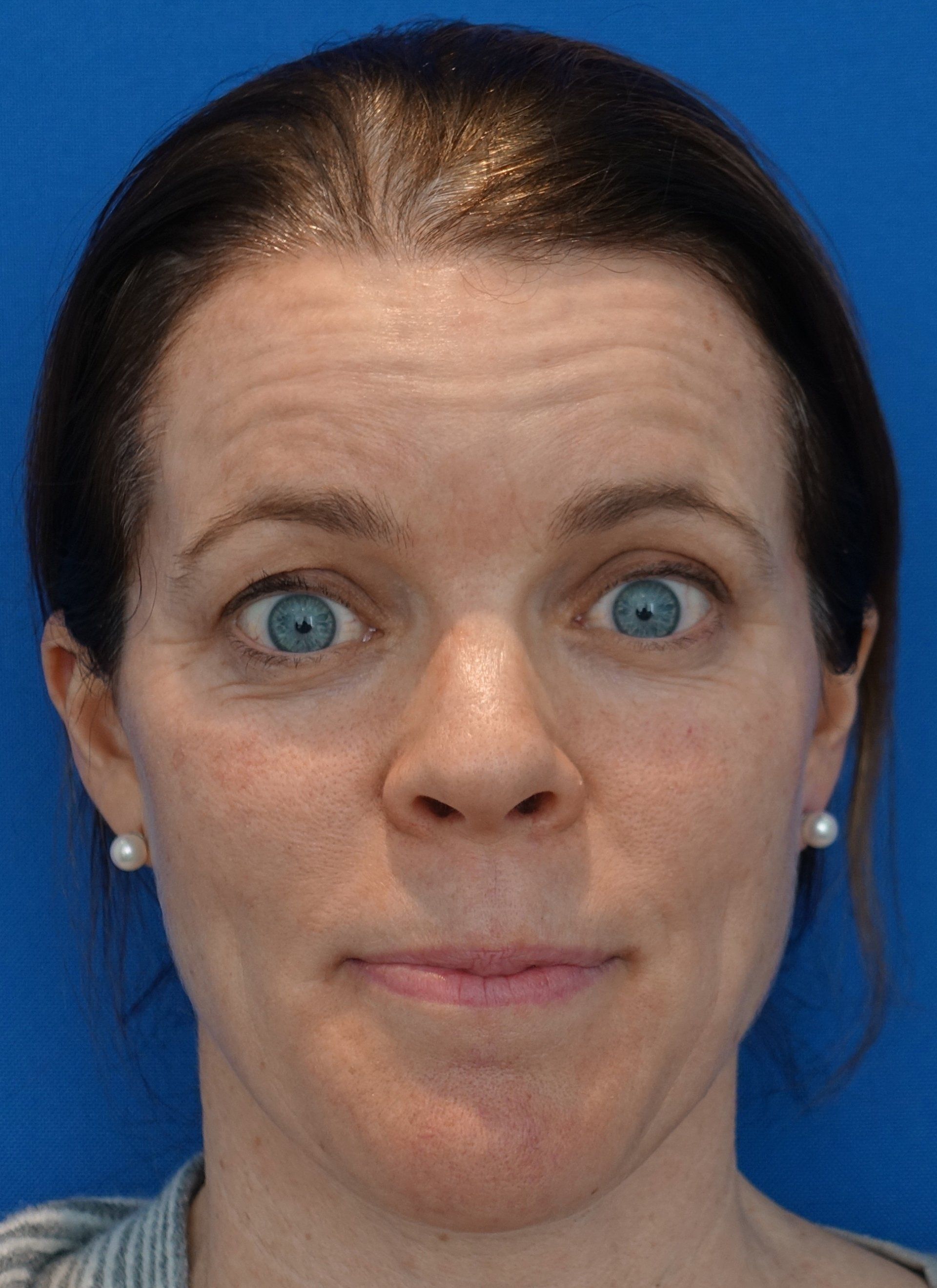 Botox pre cropped 1