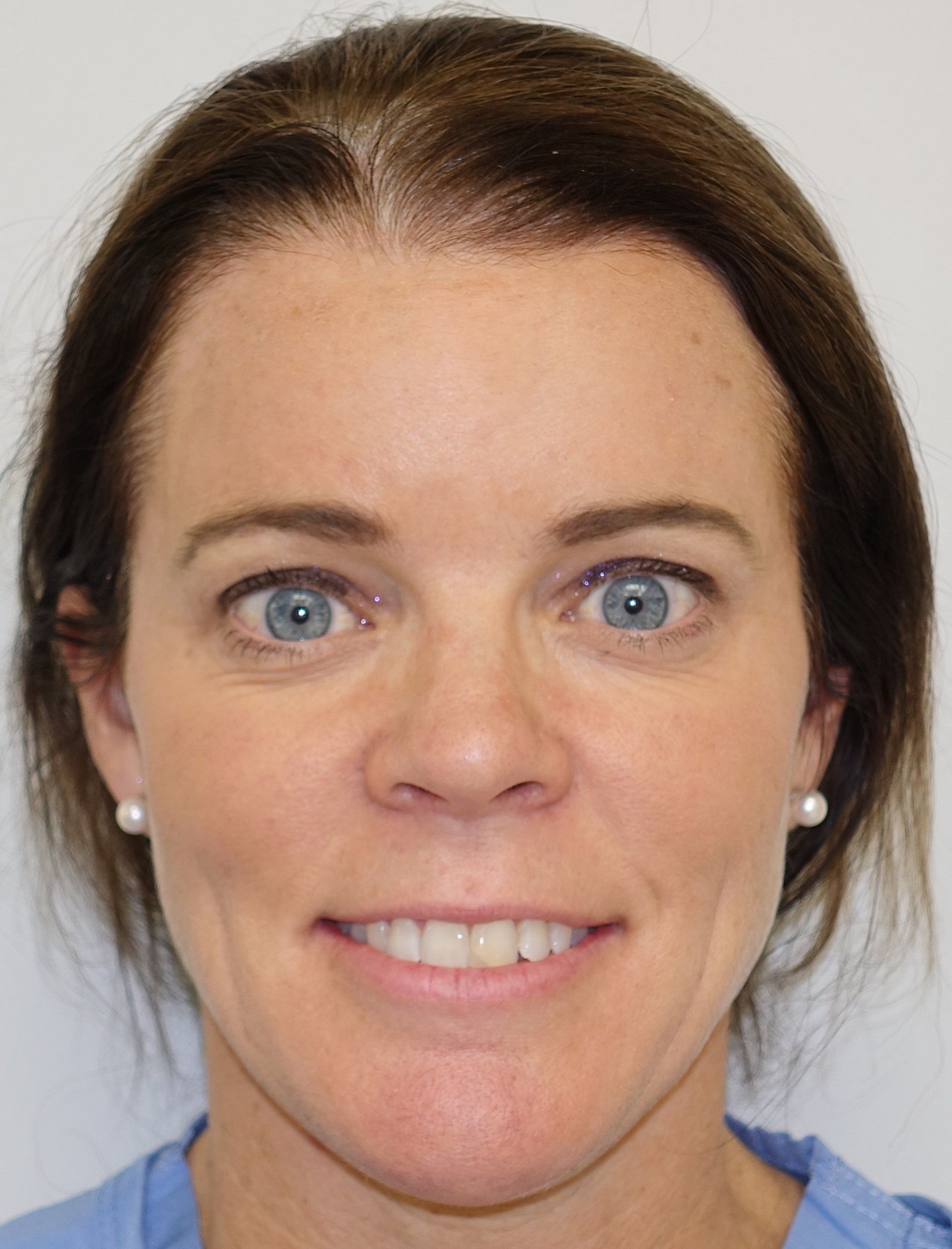 Botox cropped 1