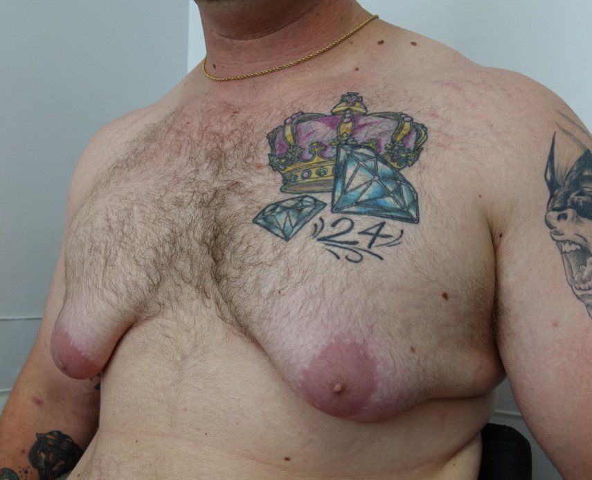 Gynecomastia pre cropped 1