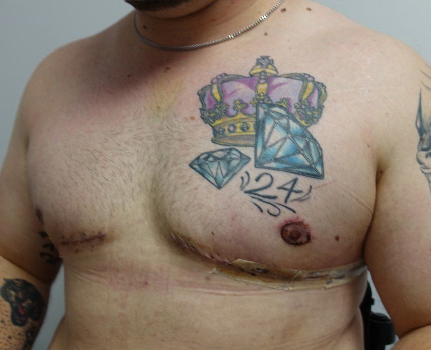 Gynecomastia cropped 3