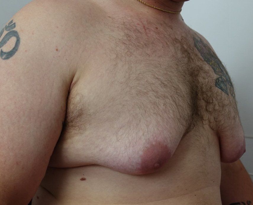 Gynecomastia pre cropped 2