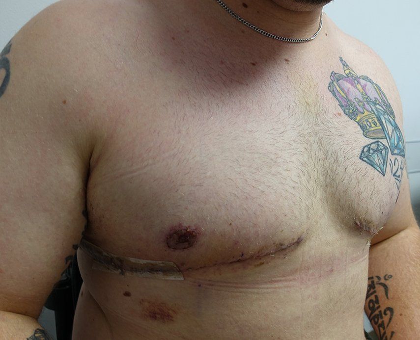 Gynecomastia cropped 2