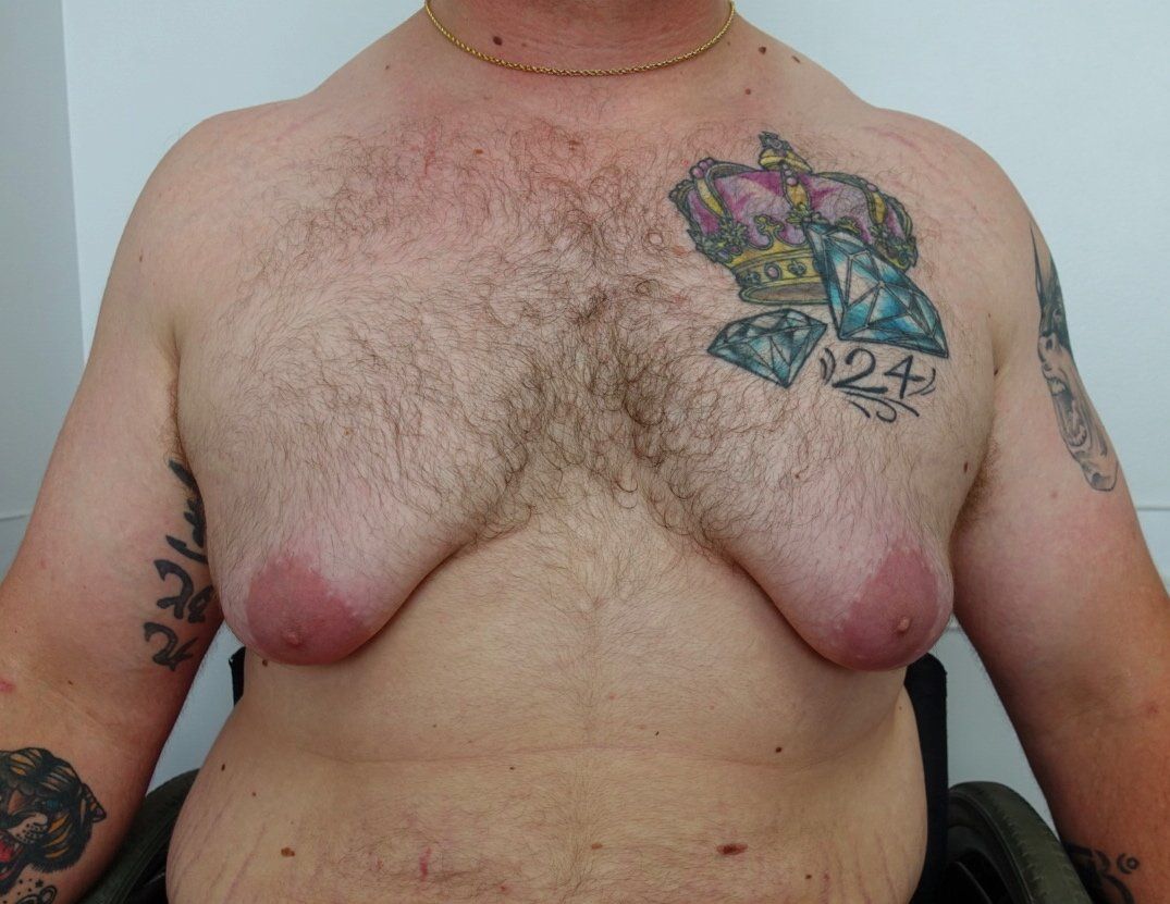 Gynecomastia pre cropped 3