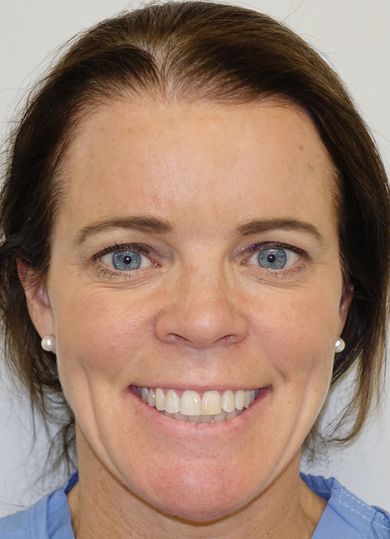 Botox smile post crop
